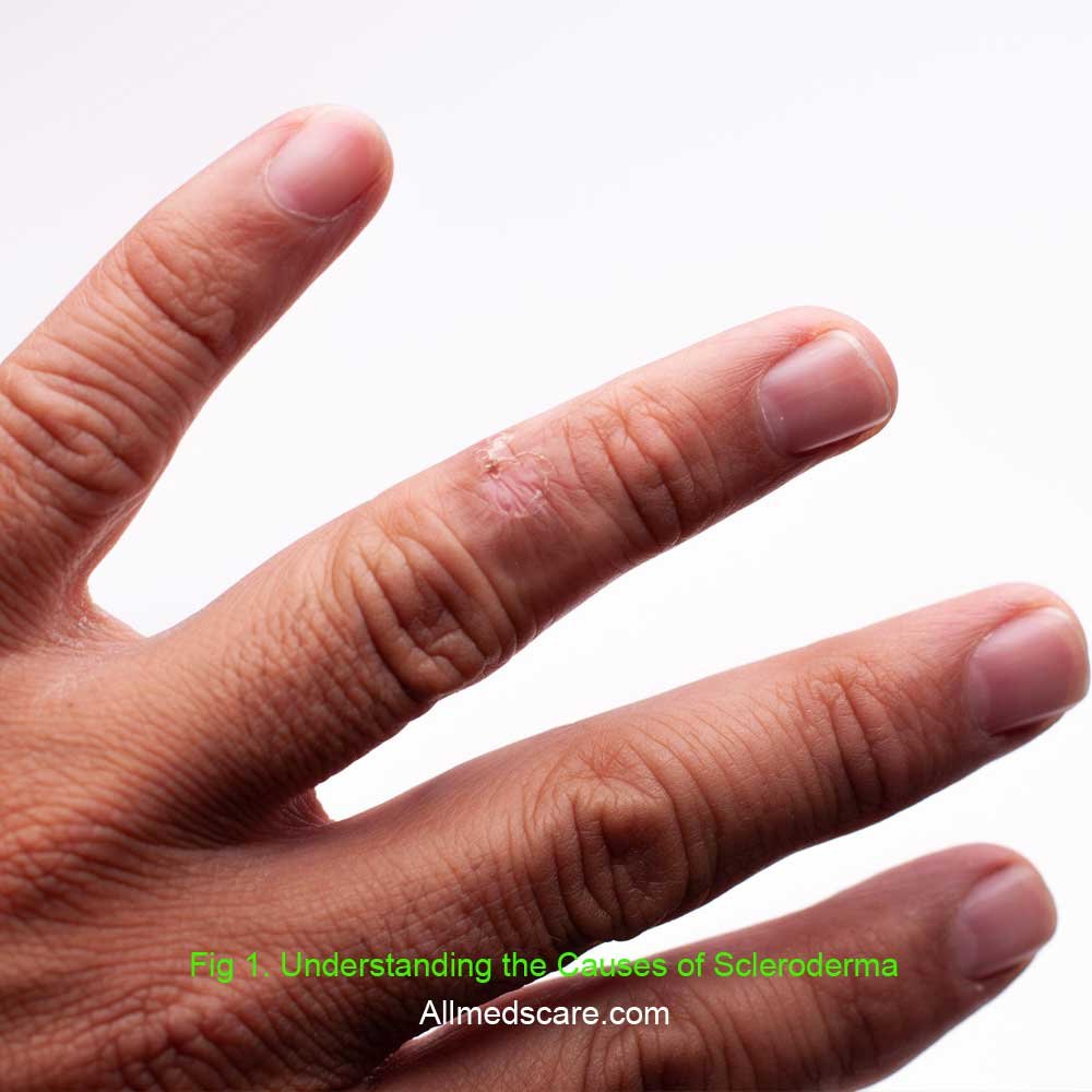 Scleroderma Information, Types and Treatments - Allmedscare.com